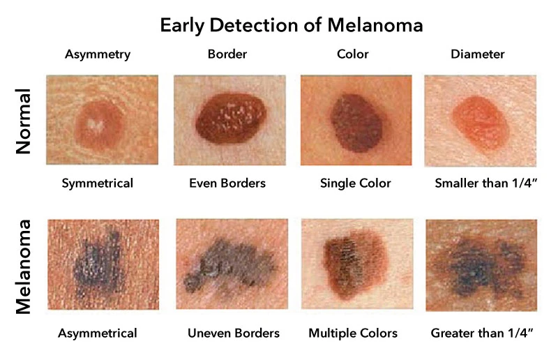 Educational illustration comparing the appearance of skin spots.